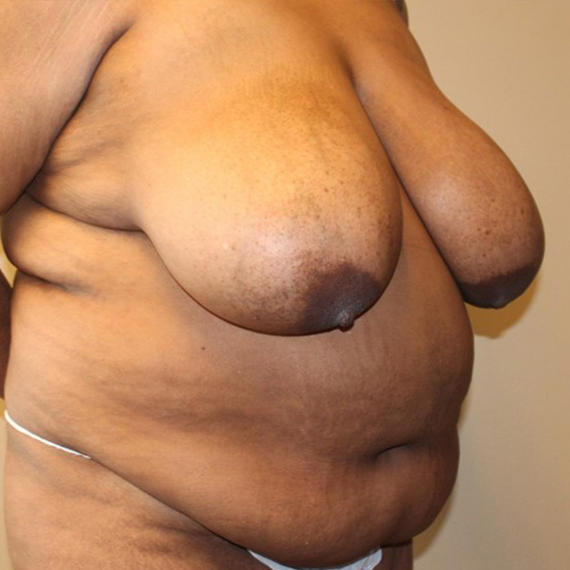 Abdominoplasty 03