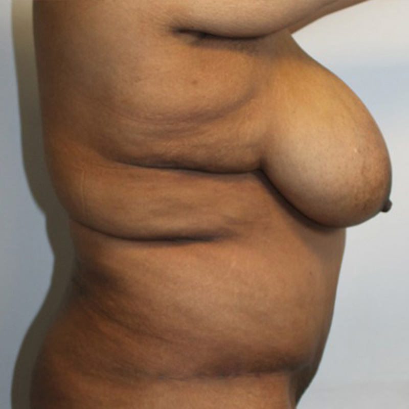 Abdominoplasty 05