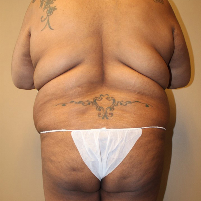 Abdominoplasty 11