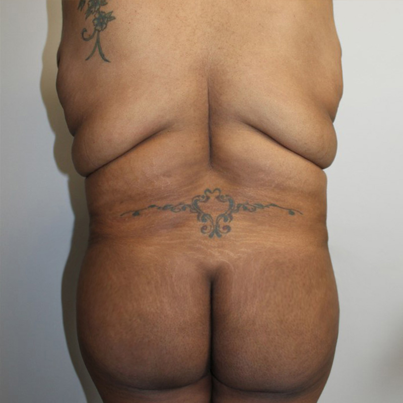 Abdominoplasty 11