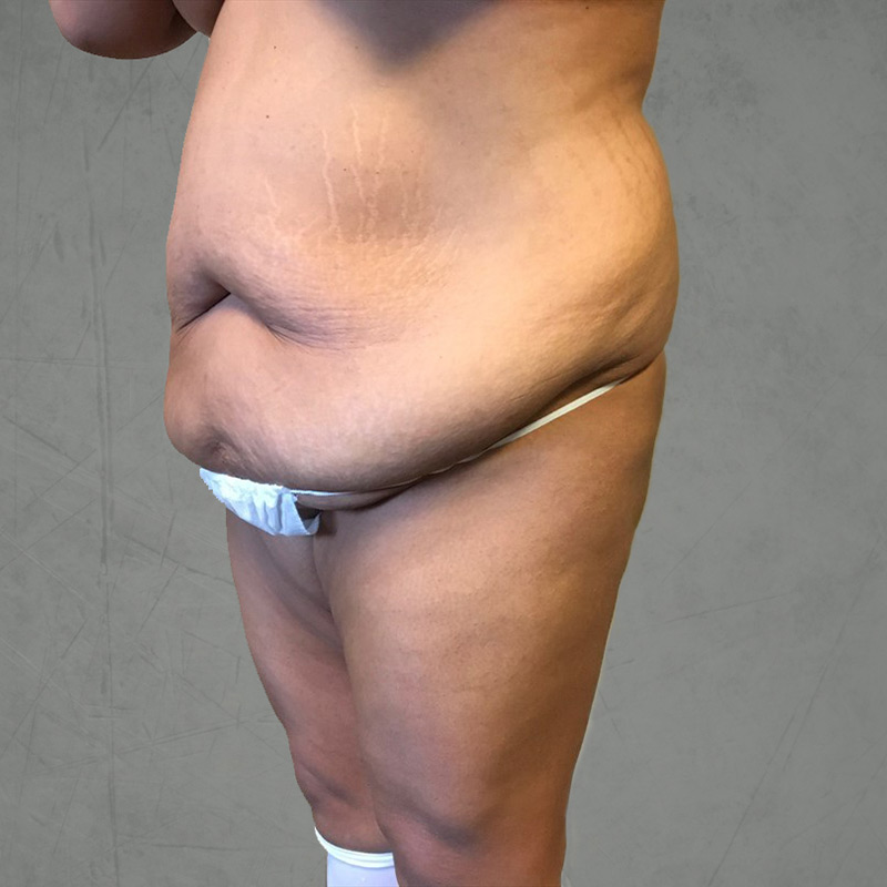 Abdominoplasty 09