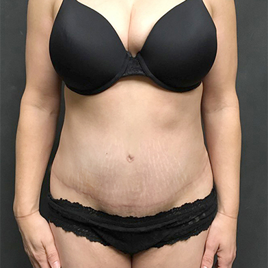 Abdominoplasty 18