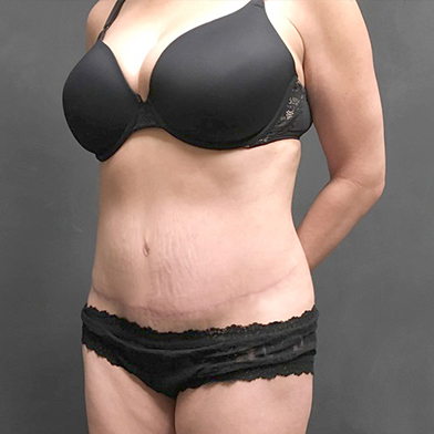 Abdominoplasty 03