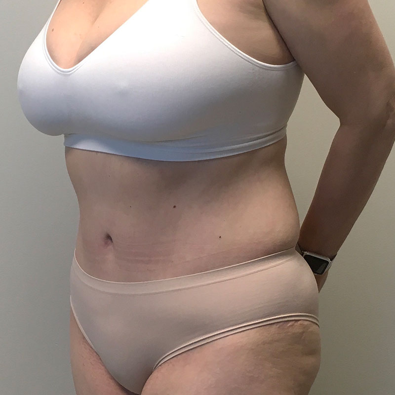 Abdominoplasty 03