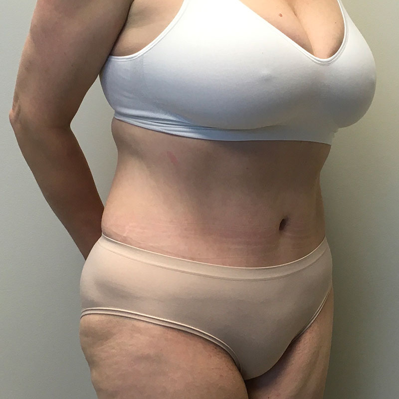 Abdominoplasty 05