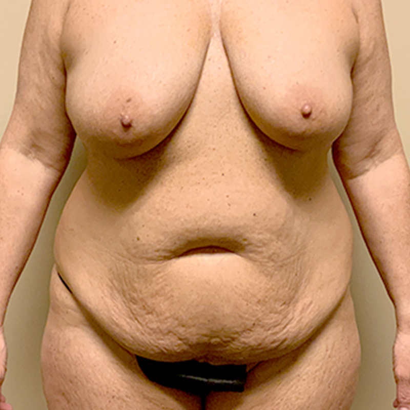 Abdominoplasty 01