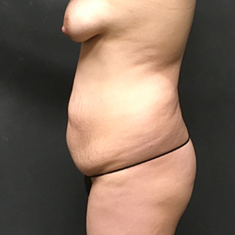 Abdominoplasty 05