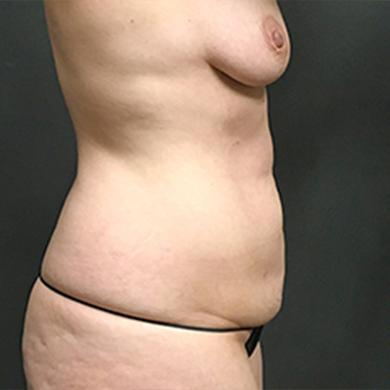 Abdominoplasty 05