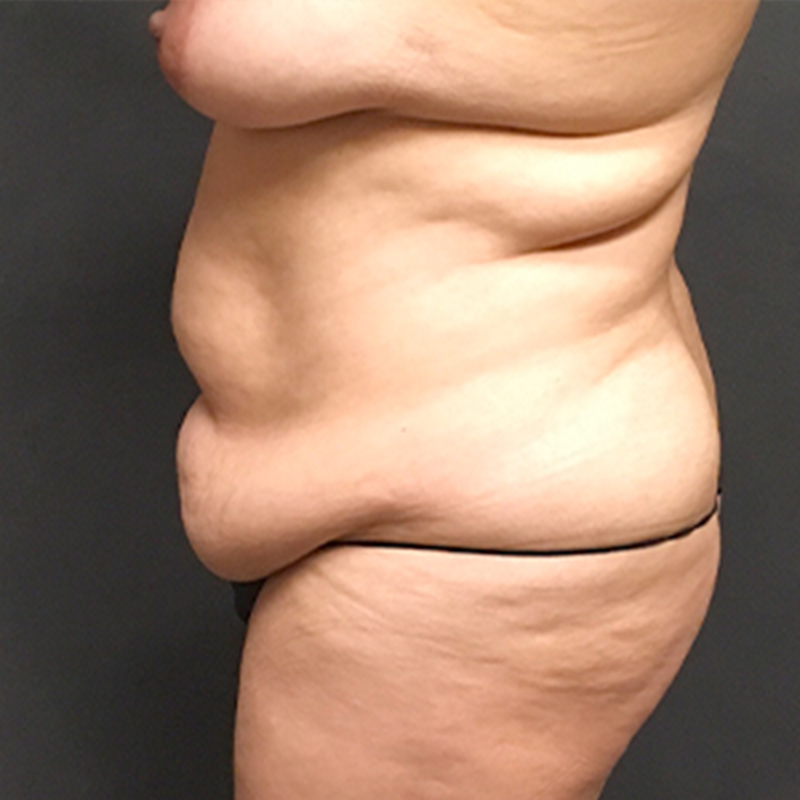 Abdominoplasty 05
