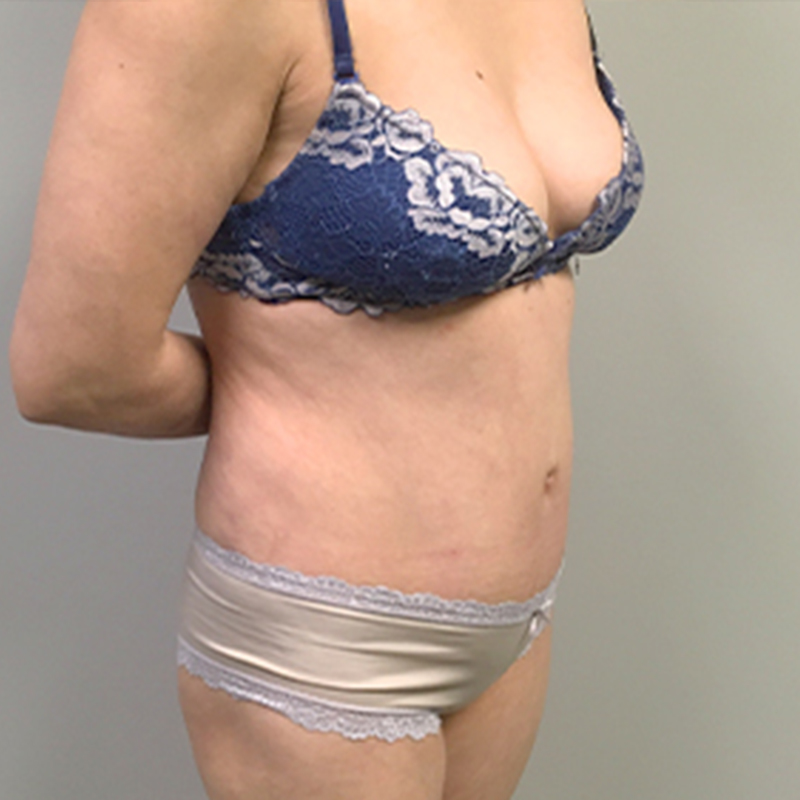 Abdominoplasty 03