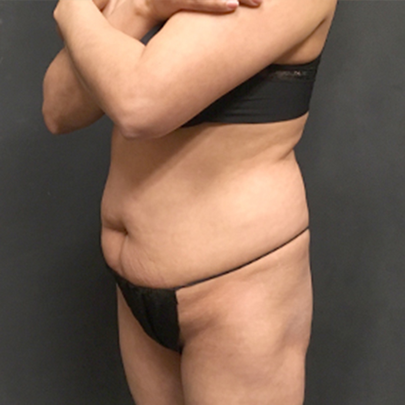 Abdominoplasty 05