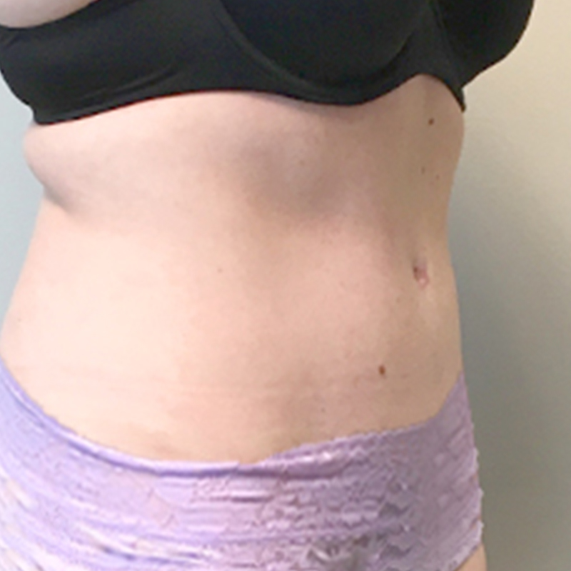 Abdominoplasty 03