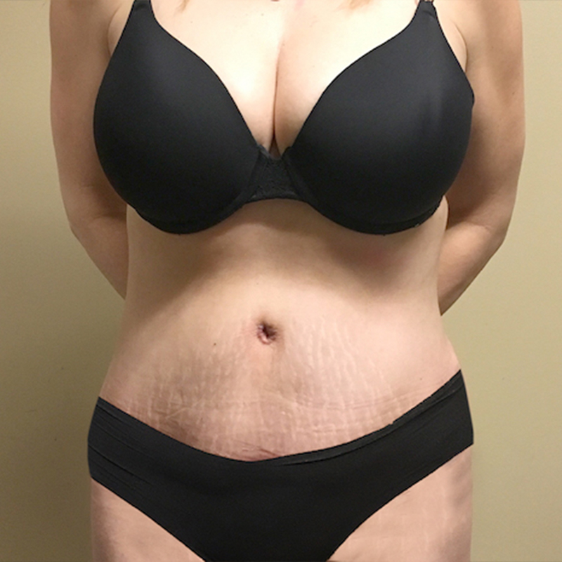 Abdominoplasty 32