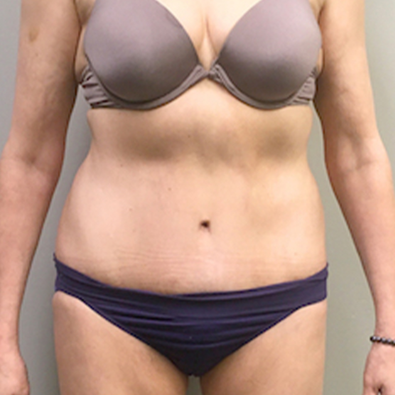 Abdominoplasty 33