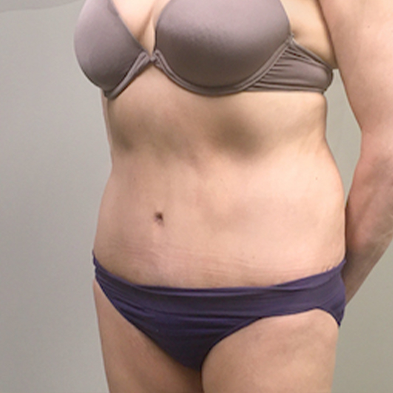 Abdominoplasty 03