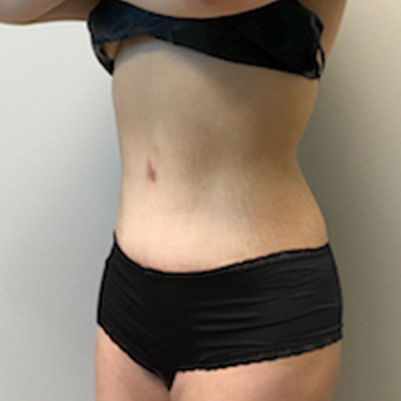 Abdominoplasty 03