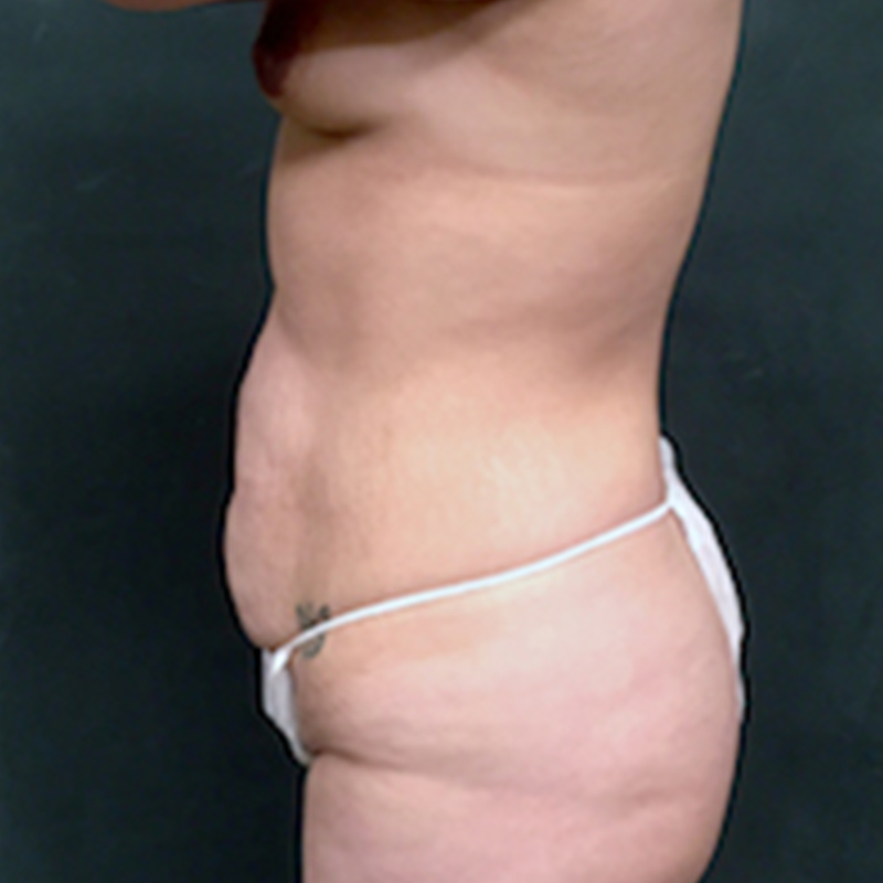 Abdominoplasty 05