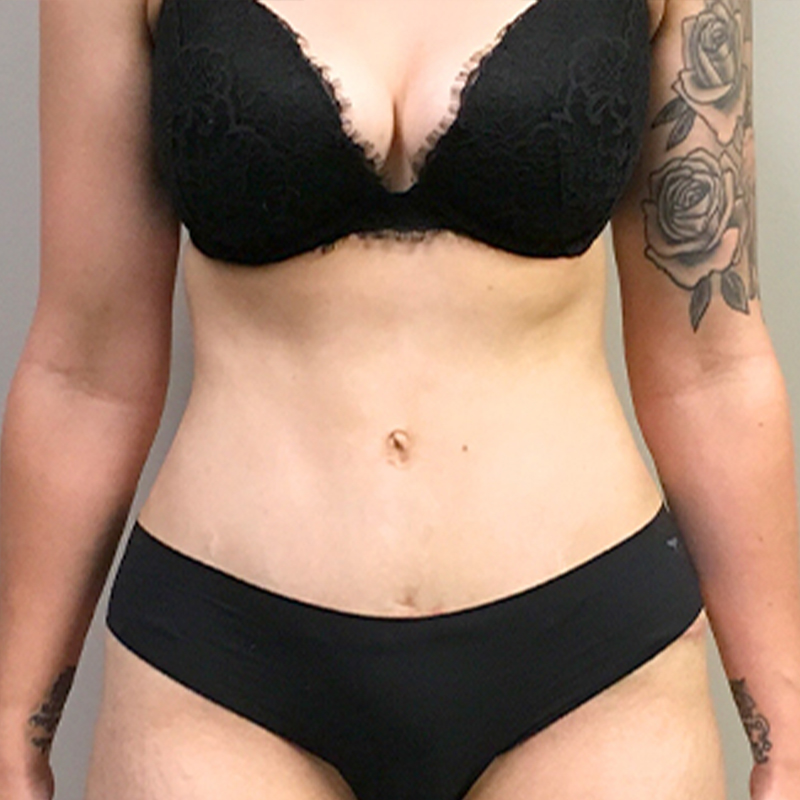 Abdominoplasty 35