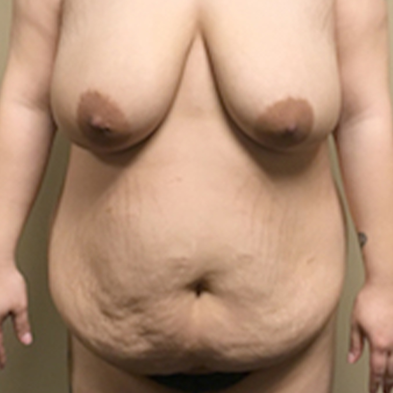 Abdominoplasty 01