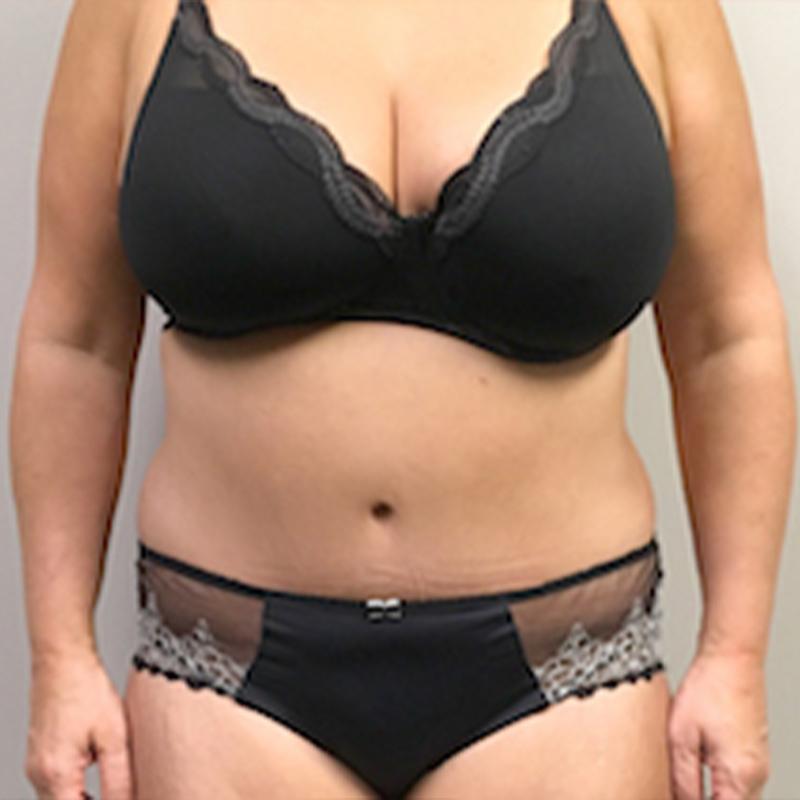 Abdominoplasty 37