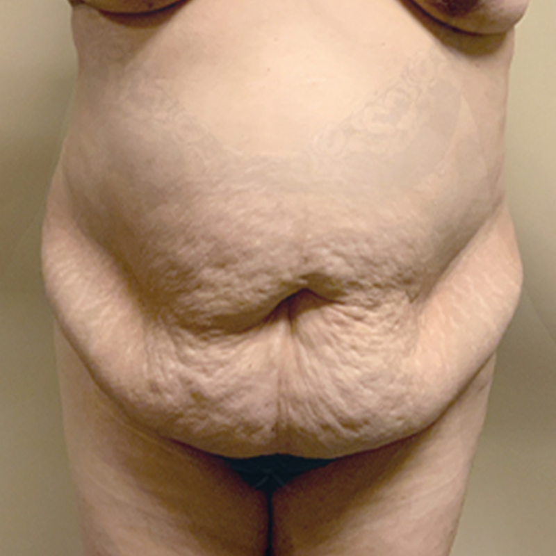 Abdominoplasty 01