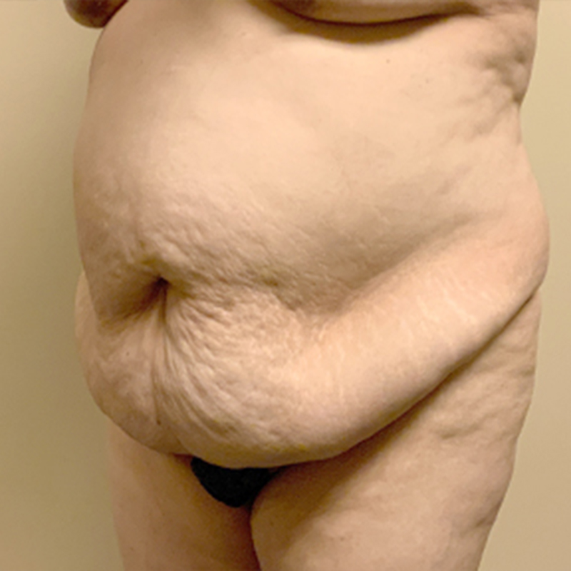 Abdominoplasty 03