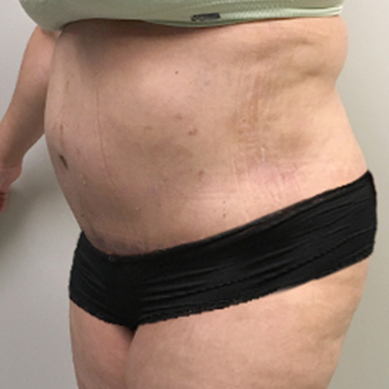 Abdominoplasty 03