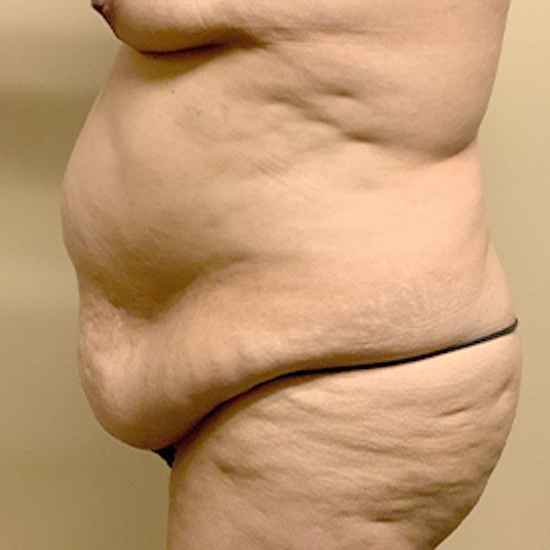 Abdominoplasty 05