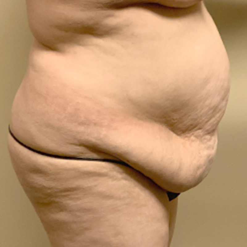 Abdominoplasty 09
