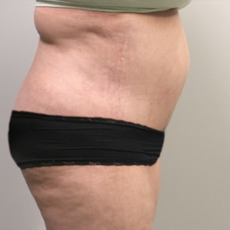 Abdominoplasty 09
