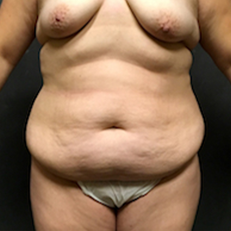 Abdominoplasty 01