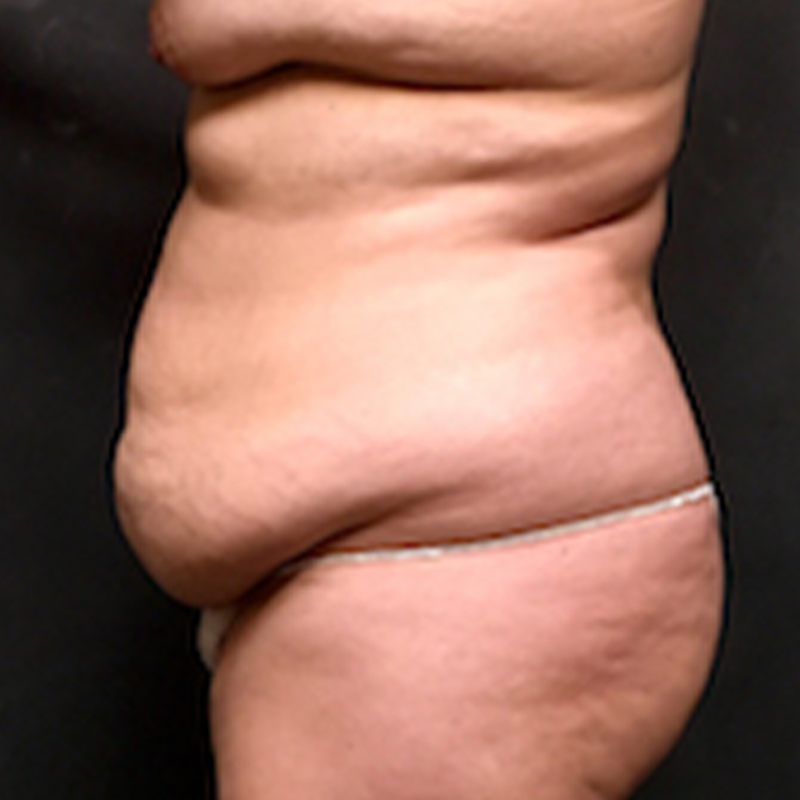 Abdominoplasty 05