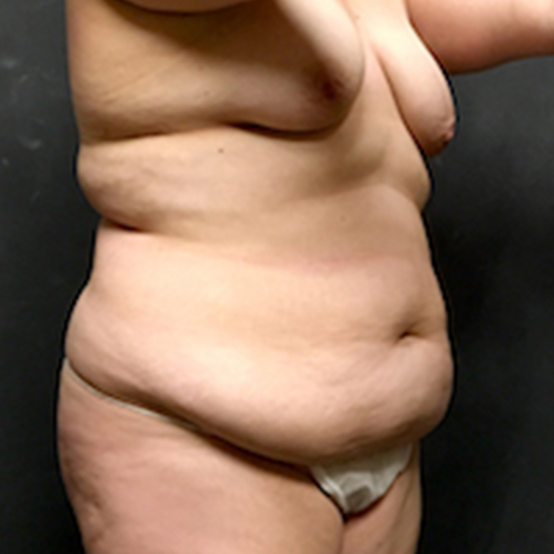 Abdominoplasty 07