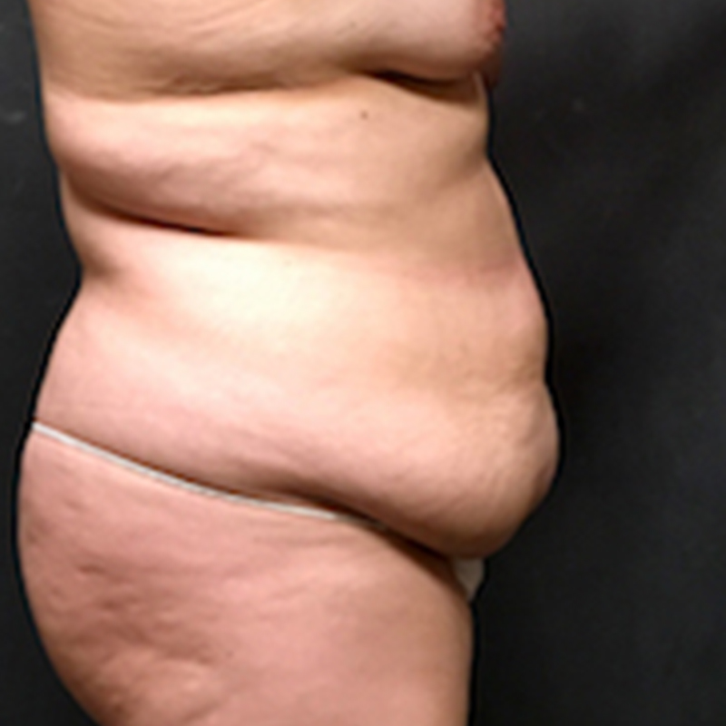 Abdominoplasty 09