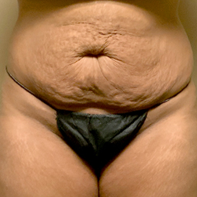 Abdominoplasty 01