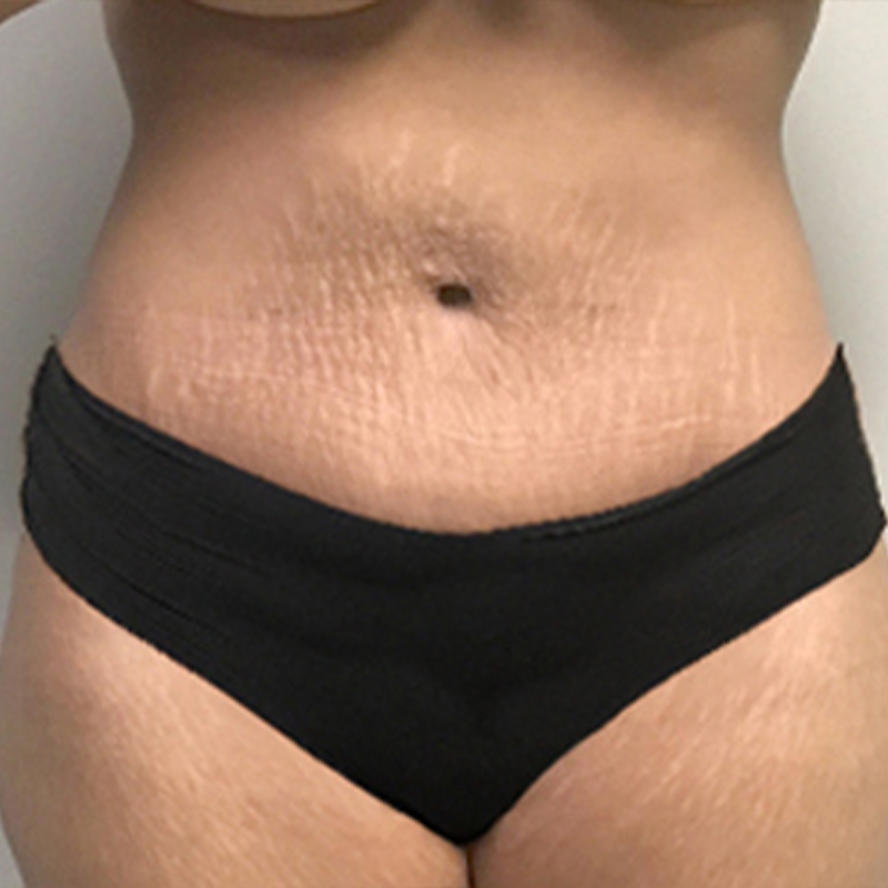 Abdominoplasty 43