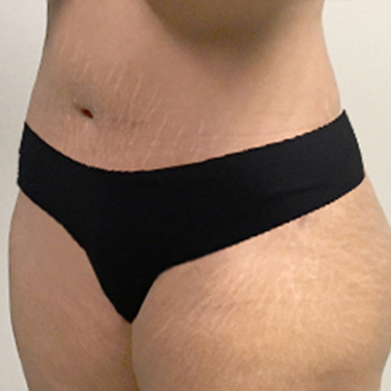 Abdominoplasty 03