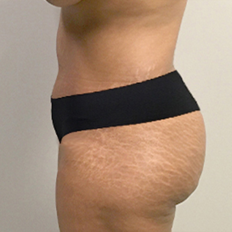 Abdominoplasty 05