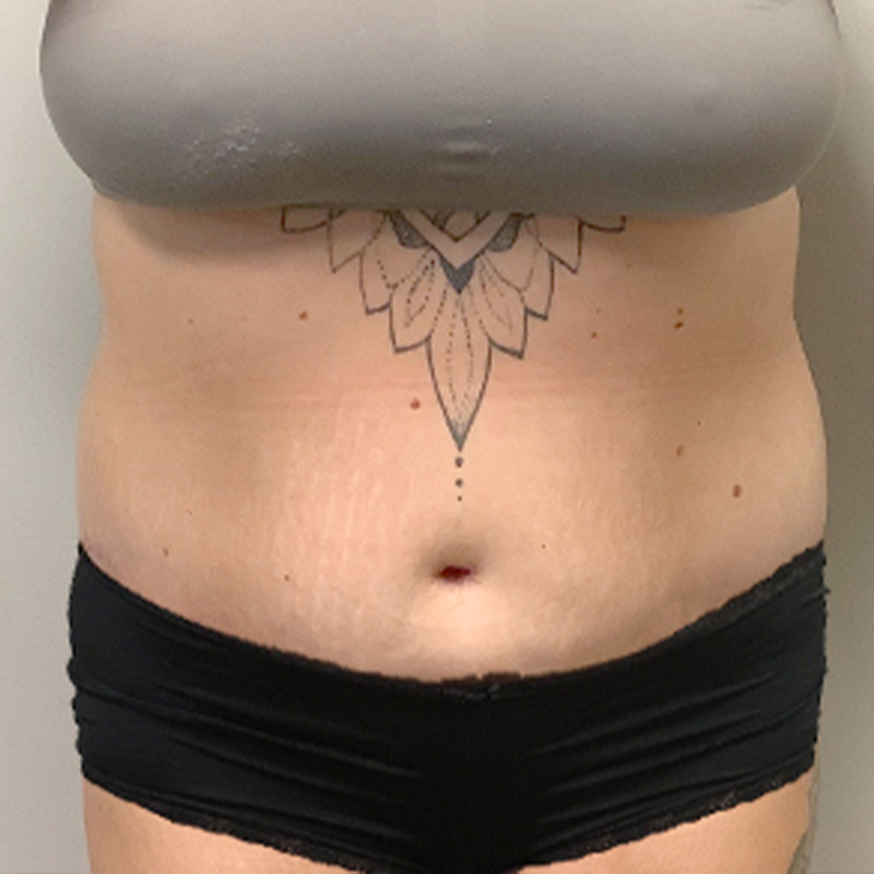 Abdominoplasty 44