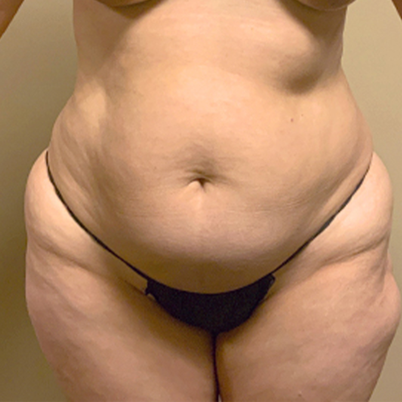 Abdominoplasty 01