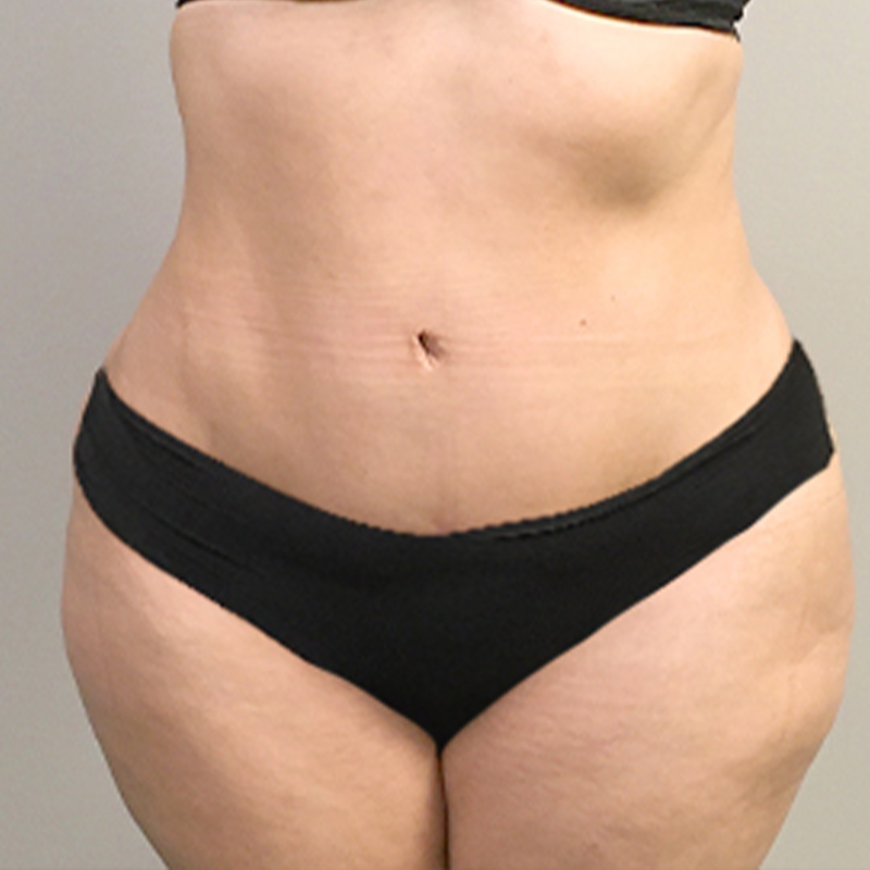 Abdominoplasty 45