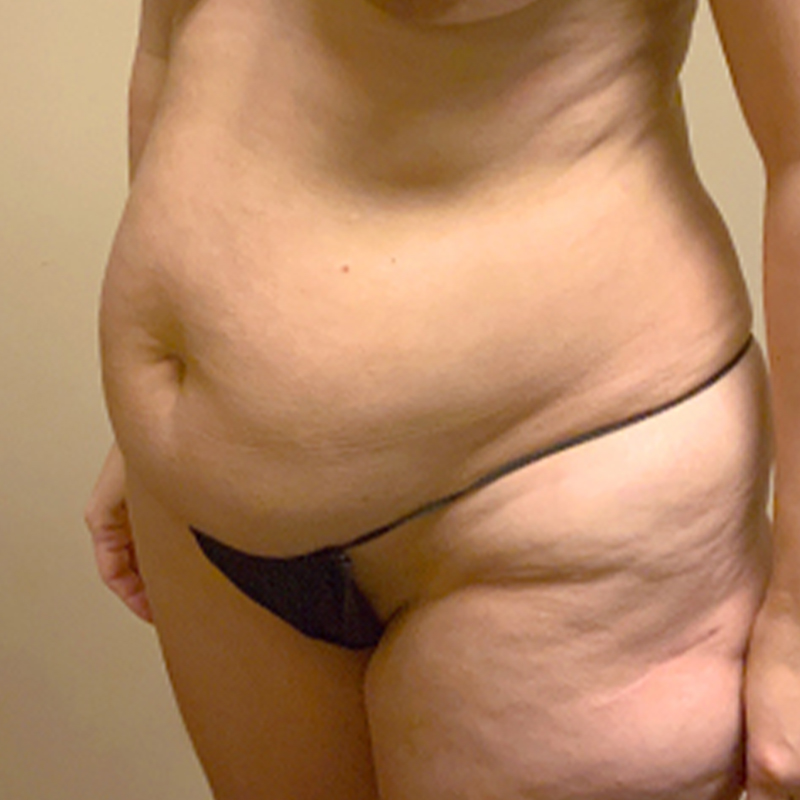 Abdominoplasty 03