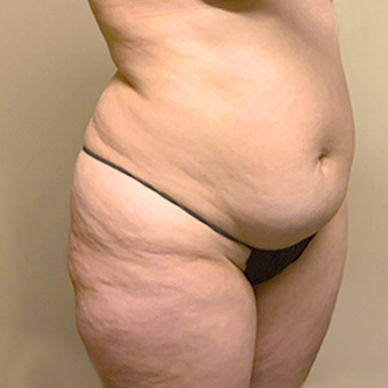 Abdominoplasty 05