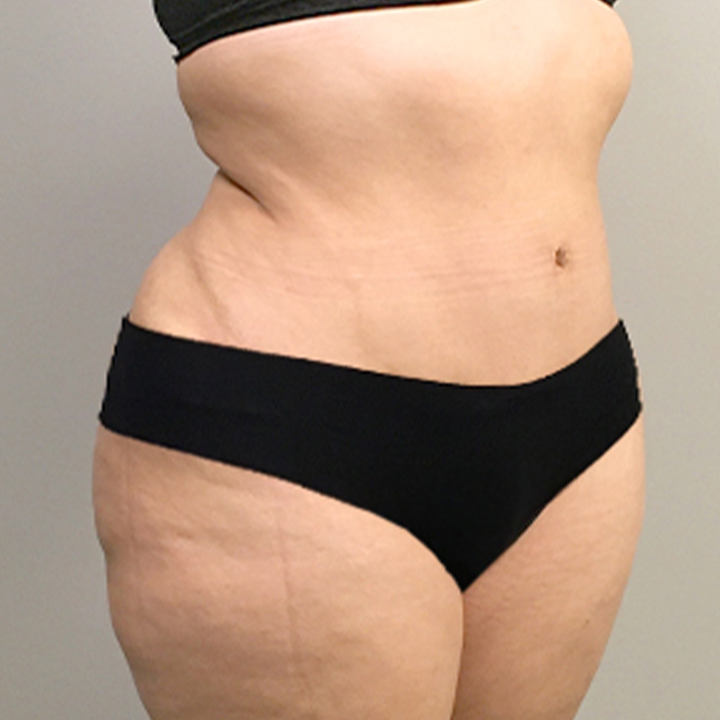 Abdominoplasty 05