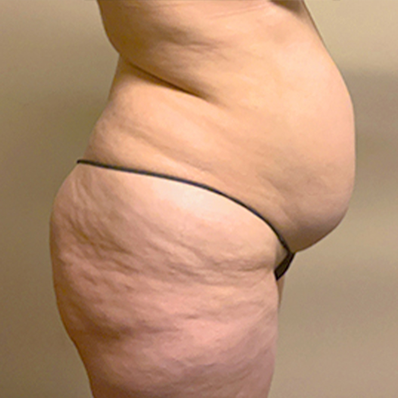 Abdominoplasty 07