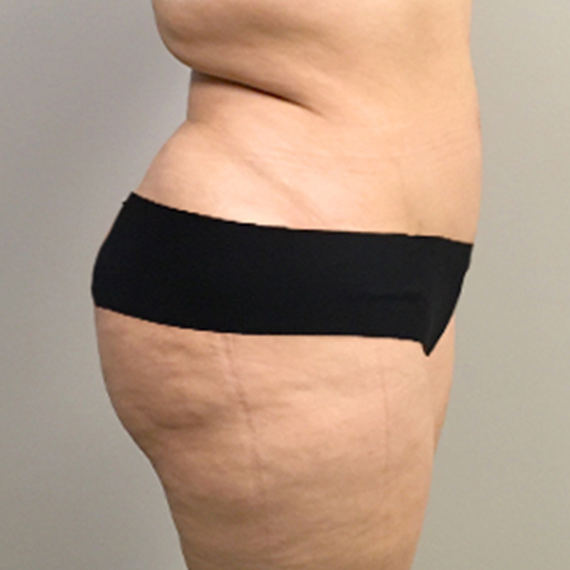Abdominoplasty 07