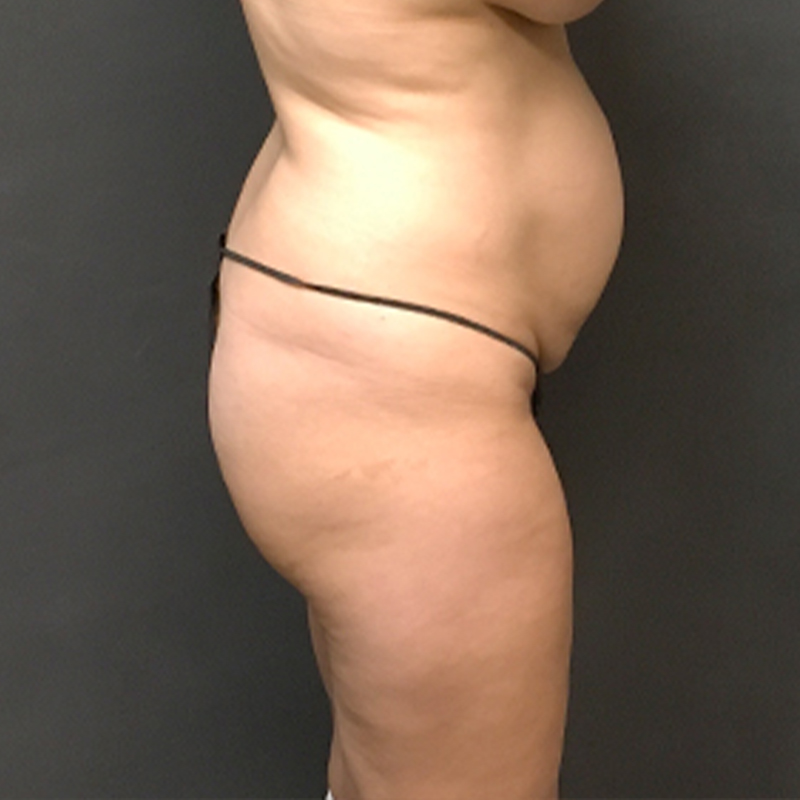 Abdominoplasty 05