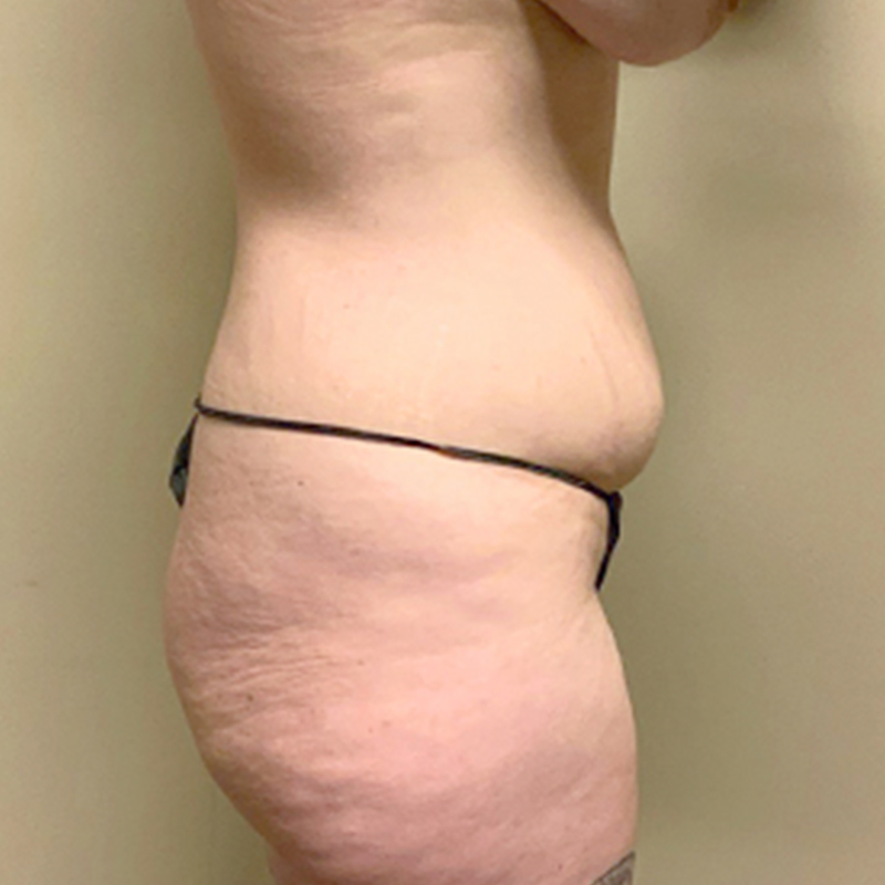 Abdominoplasty 07
