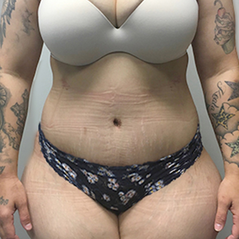 Abdominoplasty 48