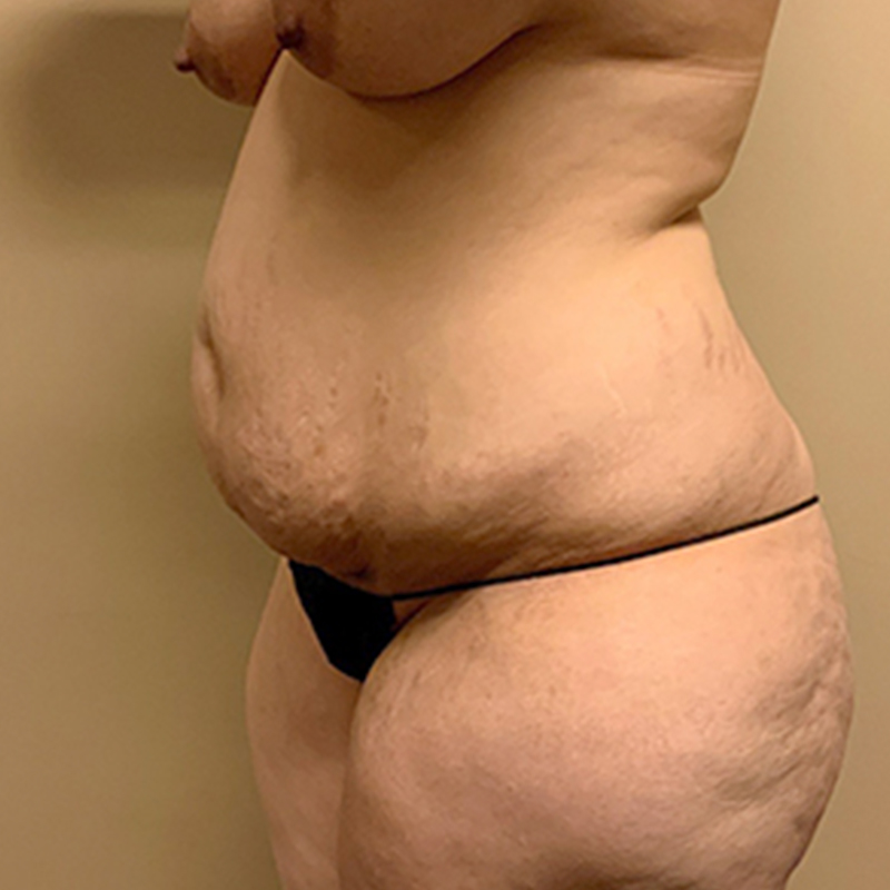 Abdominoplasty 03